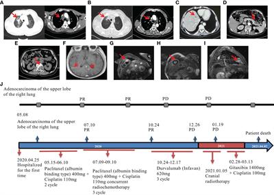 Extremely high infiltration of CD8+PD-L1+ cells detected in a stage III non-small cell lung cancer patient exhibiting hyperprogression during anti-PD-L1 immunotherapy after chemoradiation: A case report